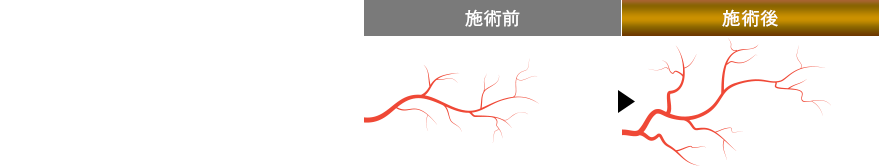 専用の機器によって陰茎に刺激を与え、血管の再生を促し、根本的な改善を目指す施術法です。
