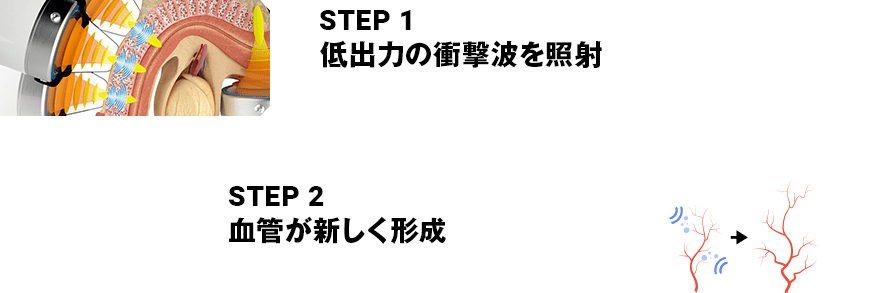 STEP1 低出力の衝撃波を照射 STEP2 血管が新しく形成