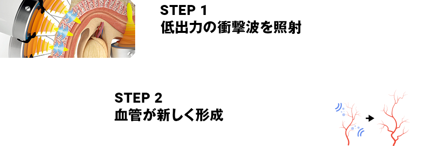 STEP1 低出力の衝撃波を照射 STEP2 血管が新しく形成