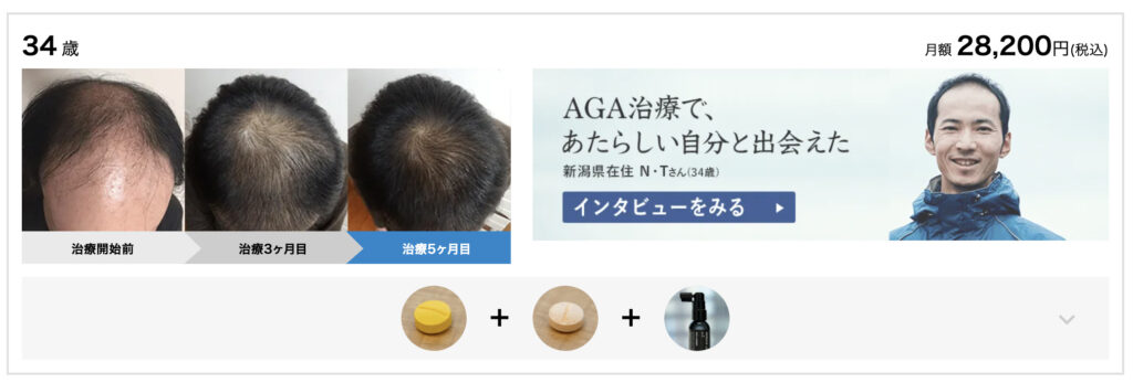 おすすめの薄毛専門AGAクリニック12選_AGAヘアクリニックの症例写真