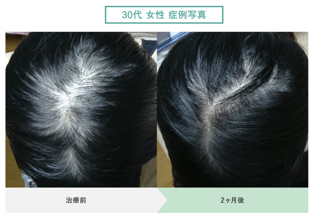 女性の薄毛専門のAGAクリニック_クリニックフォアの症例写真