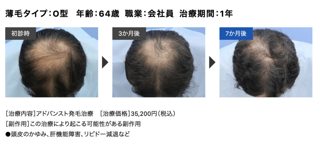 おすすめの薄毛専門AGAクリニック12選_Dクリニックの症例写真