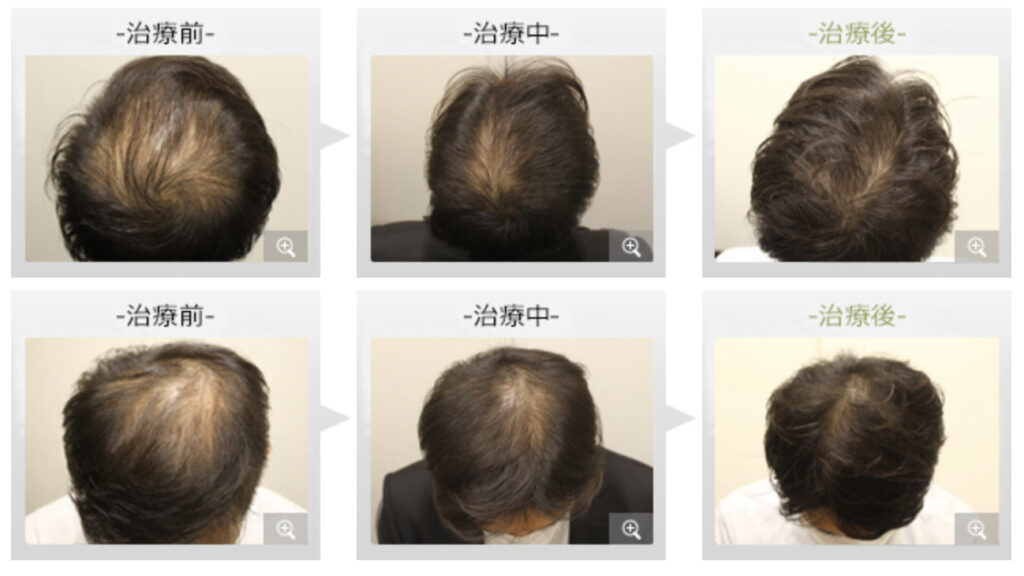 おすすめの薄毛専門AGAクリニック12選_銀座総合美容クリニックの症例写真