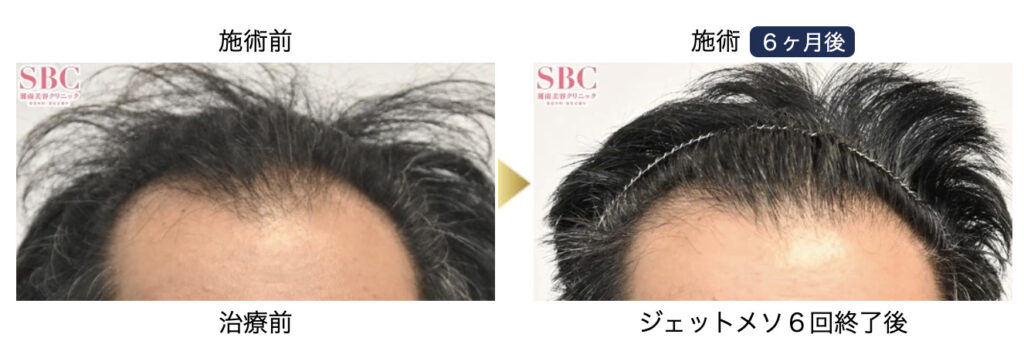 おすすめの薄毛専門AGAクリニック12選_湘南AGAクリニックの症例写真