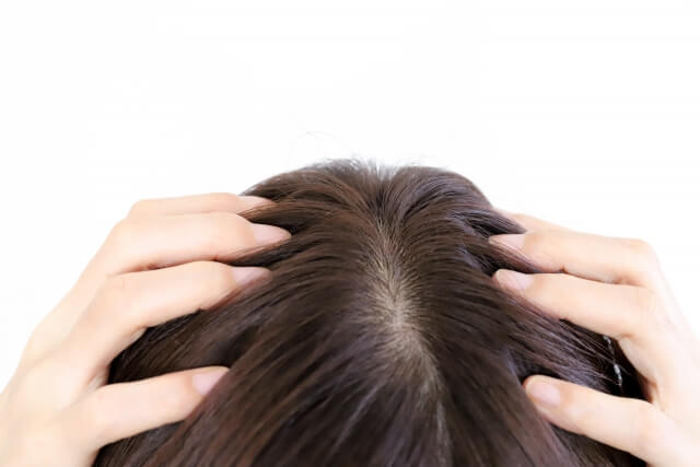 7. ジヒドロテストステロンによる脱毛にも効果的