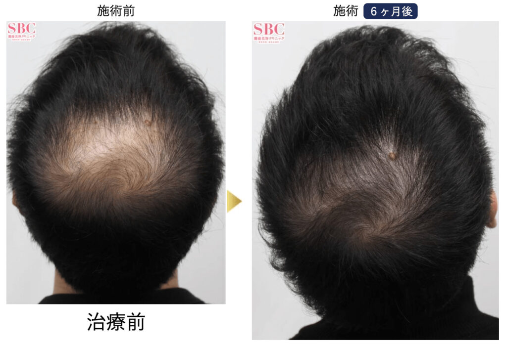 毛髪再瀬メソセラピーで治療した30代男性の症例